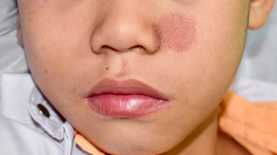 Circular Rash: Common Causes That Aren't Ringworm