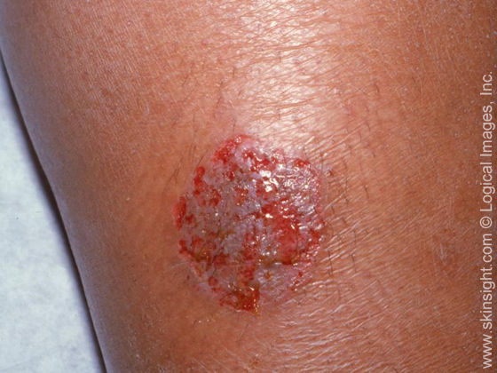 Nummular Dermatitis: Foothill Dermatology Medical Center: Dermatology