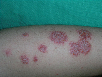 RED RASHES ON THE SKIN? READ THIS INFORMATIVE DEEP-DIVE | Mya Care