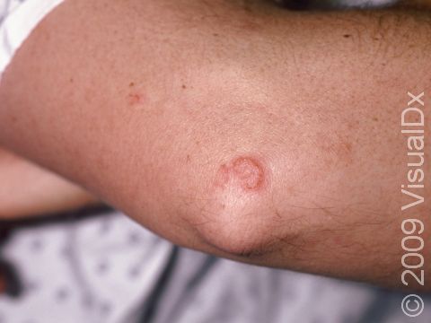 Discoid eczema. Discoid eczema | DermNet